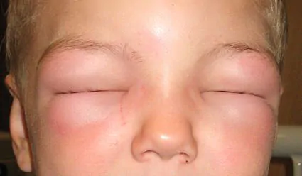 img-wpd-angioedema2010