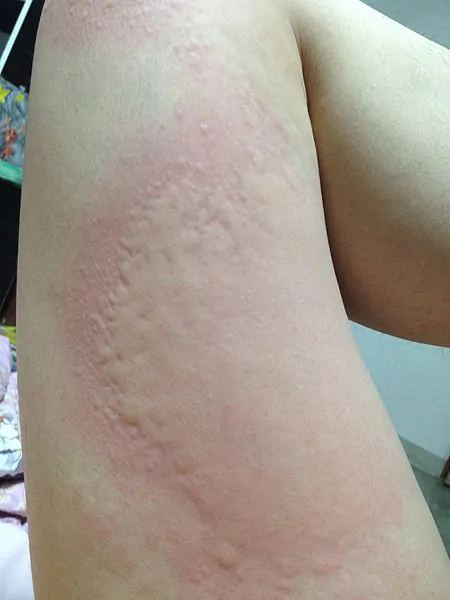 img-wpd_urticaria_2