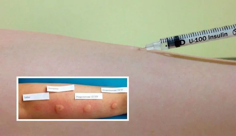 Teste Intradérmico