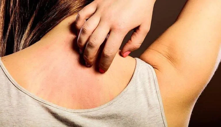 Urticária e Angioedema